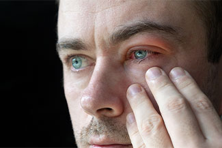 Blepharitis Thumbnail